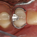 Final postoperative photographs. Partial denture inserted; the ideal fit was achieved without the need for any adjustments on the milled restoration.
