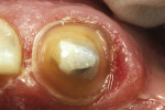 Figure 2  Incisal view of the prepared tooth. Note the increased reduction (2 mm) on thelingual surface.