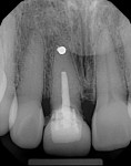 Fig. 1 Periapical radiograph of endodontically treated tooth No. 8; porcelain jacket crown (recurrent caries) over resin buildup.