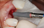Fig. 2 The 4.5-mm x 16-mm Genesis implant pre-insertion; note the pink collar.