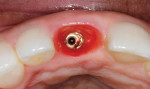 Fig. 4 Incisal view, gingival emergence profile resulting from contact with provisional, position No. 8.