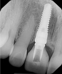 Fig. 7 Final periapical view (Visit 7), showing the implant, abutment, and crown in position No. 8.