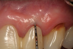 Fig. 9 Midfacial probing, tooth No. 10 (Visit 1).