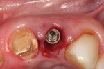 Fig. 10 Incisal view, 3.8-mm x 16-mm Genesis implant immediately after placement, position No. 10 (Visit 2).