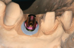 Fig. 12 Laboratory model created by attaching implant analog to abutment, seating abutment (with transfer) in impression, and pouring stone around transfer.