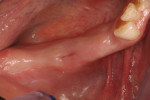 Fig. 16 Partially edentulous mandibular right alveolar ridge after extraction of non-restorable teeth Nos. 28 and 30 (Visit 1).
