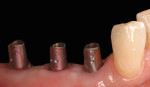 Fig. 18 Prefabricated pink Genesis abutments (two 4.5-mm, one 5.5-mm Ti Temporary), customized by preparation just below the gingival margin and torquing to 30 Ncm, prior to final closed-tray impression (Visit 3). No provisionalization used.