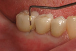 Fig. 19 The final PFM crowns in position Nos. 28 through 30. Mesiofacial probing, implant crown in position No. 30 showing ~2 mm (Visit 7).