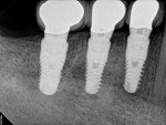 Fig. 21 Final periapical radiograph showing the Genesis implants, customized abutments, and PFM crowns in position Nos. 28 through 30 (Visit 7).