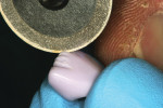Figure 15  Supplemental grooves were placed inthe incisal edge using a double-sided diamond disk.The grooves must be rounded off and not sharp.
