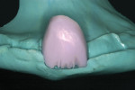 Figure 16  The pre-crystallized crown with theincisal cut-back placed in the silicone index.