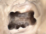 Figure 1  An upper first molar with seven canals.Image was taken with an intraoral video camera.