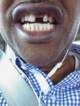 Patient presented with a tooth fractured while traveling.