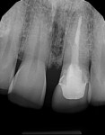 Radiograph showed overly aggressive restorative care that weakened the structural predictability.