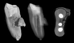 Figure 2  A lower first molar mesial root. The left image is a voxel model from the mCT scan, the middleimage is a radiographic derived from the mCT scan, and the right image is a slice from the mCTdata, at a level just below the furcation.