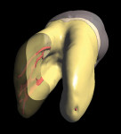 Figure 3  A polygon model of a five-canal lowerfirst molar with the mesial root apex transparent.Note the complex anatomy with three canals andfive portals of exit.