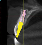 Cross-sectional image with simulated implant and abutment projection (yellow).