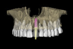 Implant simulation and adjacent roots using “selective transparency.”