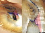 Figure 5  An upper first molar sectioned andstained to show the high curve in the MB canaland the dentine to be removed during the accessto reduce it. Sample prepared by Dr. David Clark.