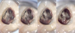 Figure 7  An upper first molar access showing considerable lateral transportation of the MB2 orifice.