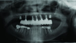 Fig 3. A patient presents with five maxillary implants to which custom abutments are attached, supporting a cement-retained bridge, and two recently placed posterior implants that are not yet connected.
