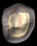 Figure 10  An upper premolar with the rootform projected onto the clinical crown. Note theovoid nature of the canal system and the narrowmesial-distal dimension of the root.