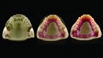 Fig 9. An in-depth edentulous cast analysis reveals a large discrepancy between the tooth positions of the porcelain bridge and the proposed tooth positions.
