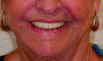 Fig 10. Patient photos show a lack of any buccal corridor.