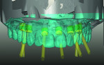 Fig 17. A double scan is carried out to enable design of the primary telescopic abutments within the volume of the approved tooth positions.
