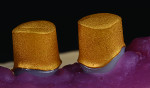 Fig 22. The secondary Galvano telescopes are refined and fit to the primary zirconia telescopic abutments.