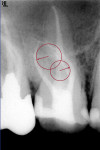 Figure 12  An upper first molar with a difficulthigh, sharp curve in the MB root.