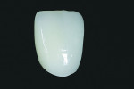 Fig 5. Full-contour Zenostar MT posterior restoration before Ivocolor Universal stain.