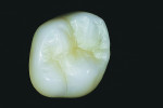 Fig 2. Traditional Zenostar zirconia framework with full IPS e.max Ceram Power dentin, enamel, and modifier buildup, showing increased brightness.