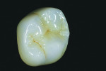 Fig 6. Full-contour Zenostar MT posterior restoration after Ivoccolor Universal stain and polish.