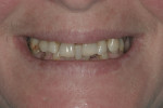 Fig 3. Excessive diastema as a consequence
of chewing pattern and advanced periodontal disease.