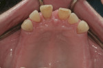 Fig 8. Flaring of the upper teeth due to the advanced periodontal disease.