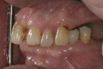 Fig 7. Loss of occlusal vertical dimension as a consequence of absence of posterior teeth.