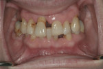 Fig 4. Note the extent of the advanced periodontal disease on tooth No. 8.