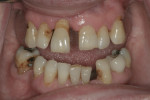 Fig 5. Irregular mandibular occlusal plane and extent of advanced periodontal disease.