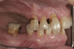 Fig 6. Tooth No. 30 had furcation involvement and a hopeless prognosis.