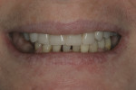 Fig 13. Lips in repose with immediate denture and finished orthodontic treatment.