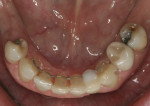 Fig 12. Closed spaces between premolars and canines after orthodontic treatment and bonded retainer, which also served as a periodontal splint.