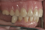 Fig 17. Improved intercuspation in posterior region as a result of limited orthodontic treatment.