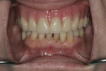 Fig 15. Final result showing improved occlusal vertical dimension and improved occlusal planes.