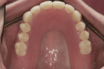 Fig 14. Final upper prosthesis in the mouth.