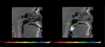 Fig 2. These CBCT images demonstrate the airway space before an oral appliance is placed (left, pre-treatment: total volume 2.2 cc; minimum area 41.1 mm2) and the increased volume of airway space with an oral appliance (right, post-treatment: total volume 12.6 cc; minimum area 306.8 mm2).