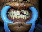 Fig 1. Preoperative clinical image showing intruded maxillary left central incisor.