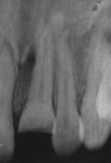 Fig 2. Intraoral periapical radiograph showing intruded maxillary left central incisor.