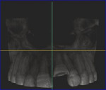 Fig 3. CBCT saggital section confirming 3 mm to 4 mm of intrusion.