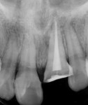 Fig 4. Post-obturation periapical radiograph.
